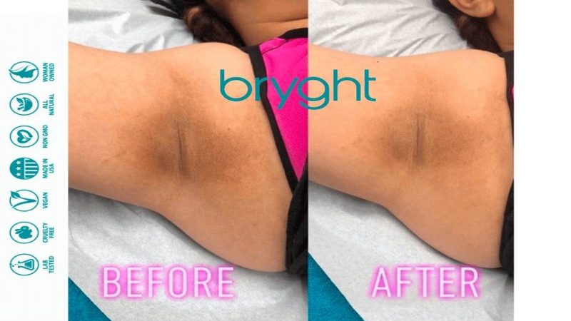 Expert Advice on Treating Underarm Ingrown Hairs